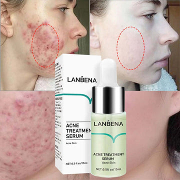Anti-Acne Solution Dark Spots Whitening Skin Shrink Pores serum